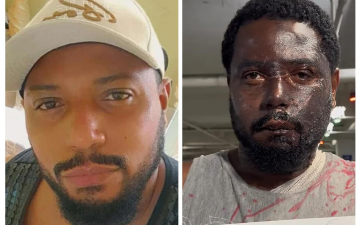 Com queimaduras pelo corpo, homem denuncia ter sido atacado pela companheira com água quente